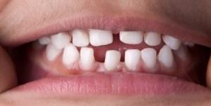 dental-bridge-small-gap