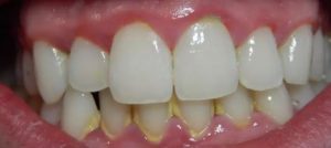 dental-cleaning-tartar-buildup
