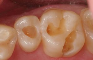 dental-filling-cavities