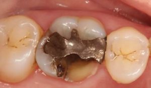 dental-filling-limitations
