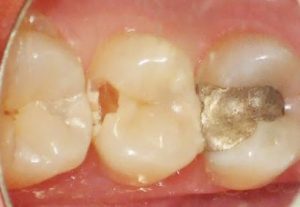 dental-filling-removing-tooth-decay