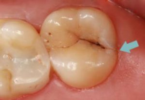dental-fillings-crack-fracture