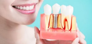 dental-implant-candidate-orange-county