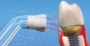 dental-implant-cleaning