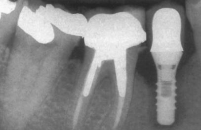 dental implants implant need failed why many enough important place