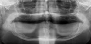 dental-implants-jaw-bone-quality