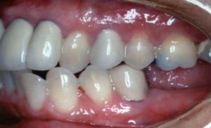 dental-implants-missing-chewing-teeth