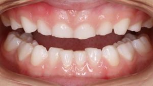dental-implants-teeth-grinding