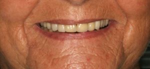 denture-benefits