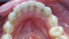 fixed-orthodontic-retainer-problem