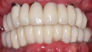 full-mouth-dental-implants