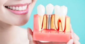 full-mouth-dental-implants-cost