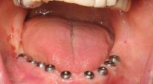 Full-mouth-versus-all-on-four-implants