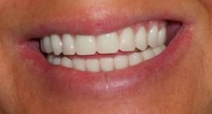 full-mouth-dental-implants-orange-county