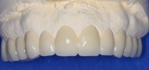 full-mouth-dental-implants-porcelain-crowns