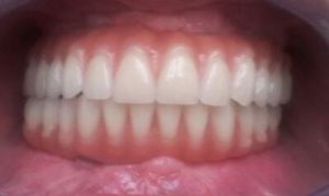 full-mouth-dental-implants-san-clemente
