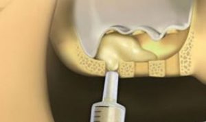 full-mouth-dental-implants-sinus-graft
