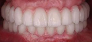 full-mouth-dental-implants-crowns-bridges