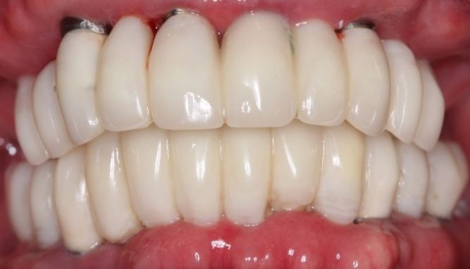 full-mouth-dental-implants