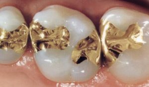 general-dentistry-dental-filling