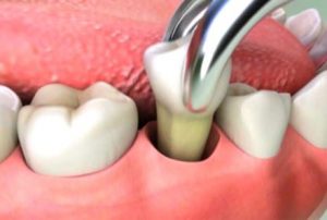 general-dentistry-tooth-extraction