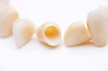 holistic-metal-free-crowns