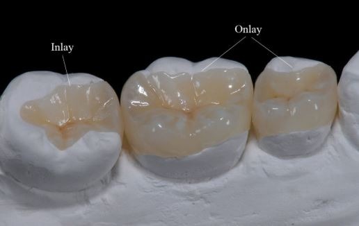 inlay-onlay-dental-filling