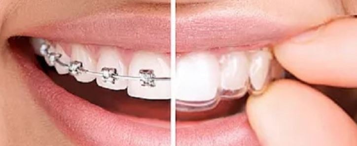 invisalign-benefit-removable