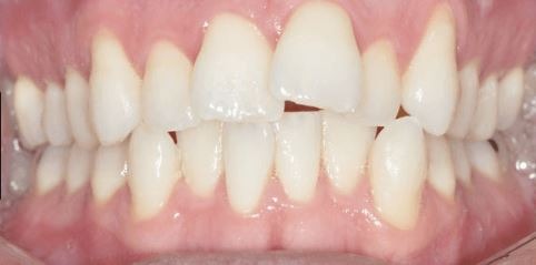 invisalign-teeth-crowding