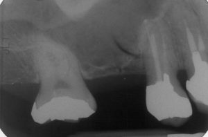 lateral-wall-sinus-graft-dental-surgery