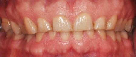 multiple-porcelain-veneers-2