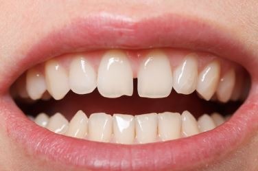multiple-porcelain-veneers