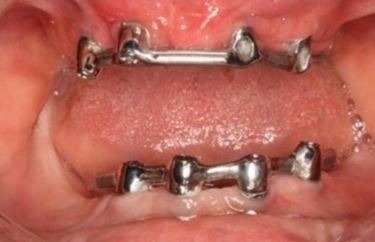 overdenture-implant-supported-bar