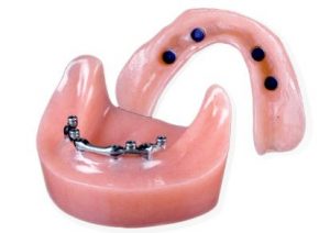 overdentures-benefits