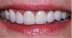 porcelain-veneers-afterwards