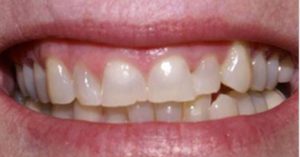 porcelain-veneers-beforehand