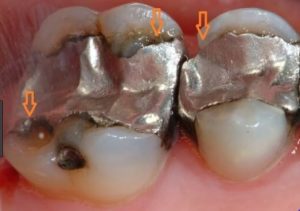 replacing-broken-silver-dental-fillings