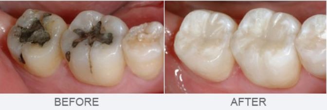 replacing-silver-white-dental-fillings