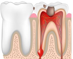 root-canal-tooth-infection