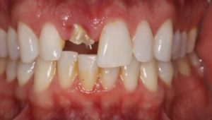 root-canal-versus-dental-implant