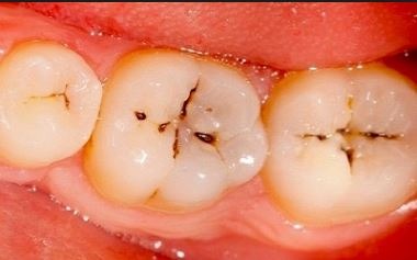 sealants-prevent-cavities