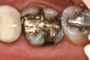 silver-fillings-contain-mercury