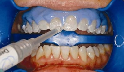 teeth-whitening-dentist-procedure