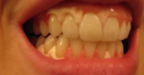 teeth-whitening-gum-damage