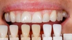 teeth-whitening-treatment-options