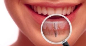 dental-implant-post-op