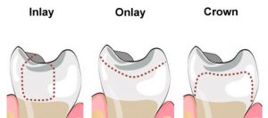 inlay-onlay-crown-comparison