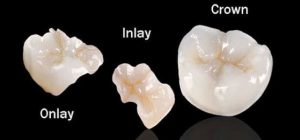 inlay-onlay-procedure