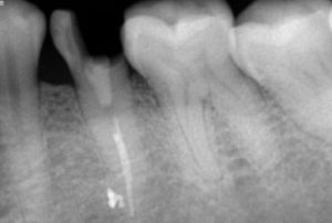 inlay-onlay-root-canal-tooth