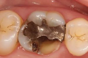 inlay-onlay-severely-broken-molar